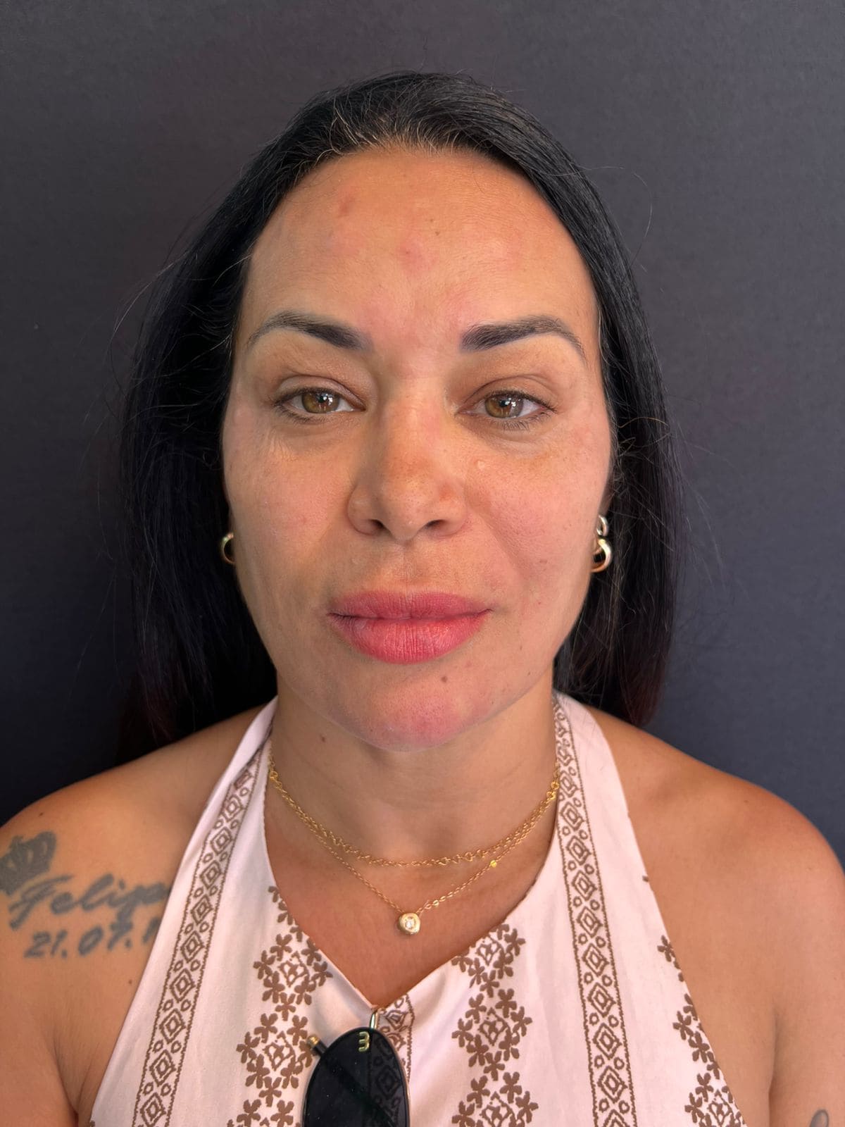 Depois - Harmonização facial