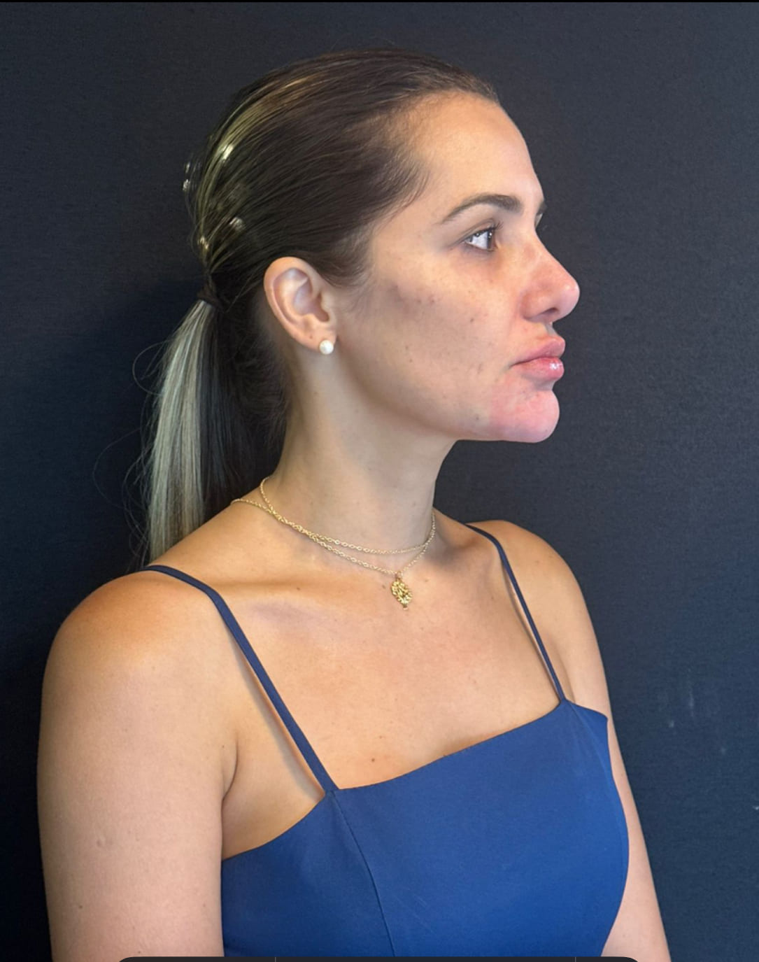 Depois - Perfil & mento