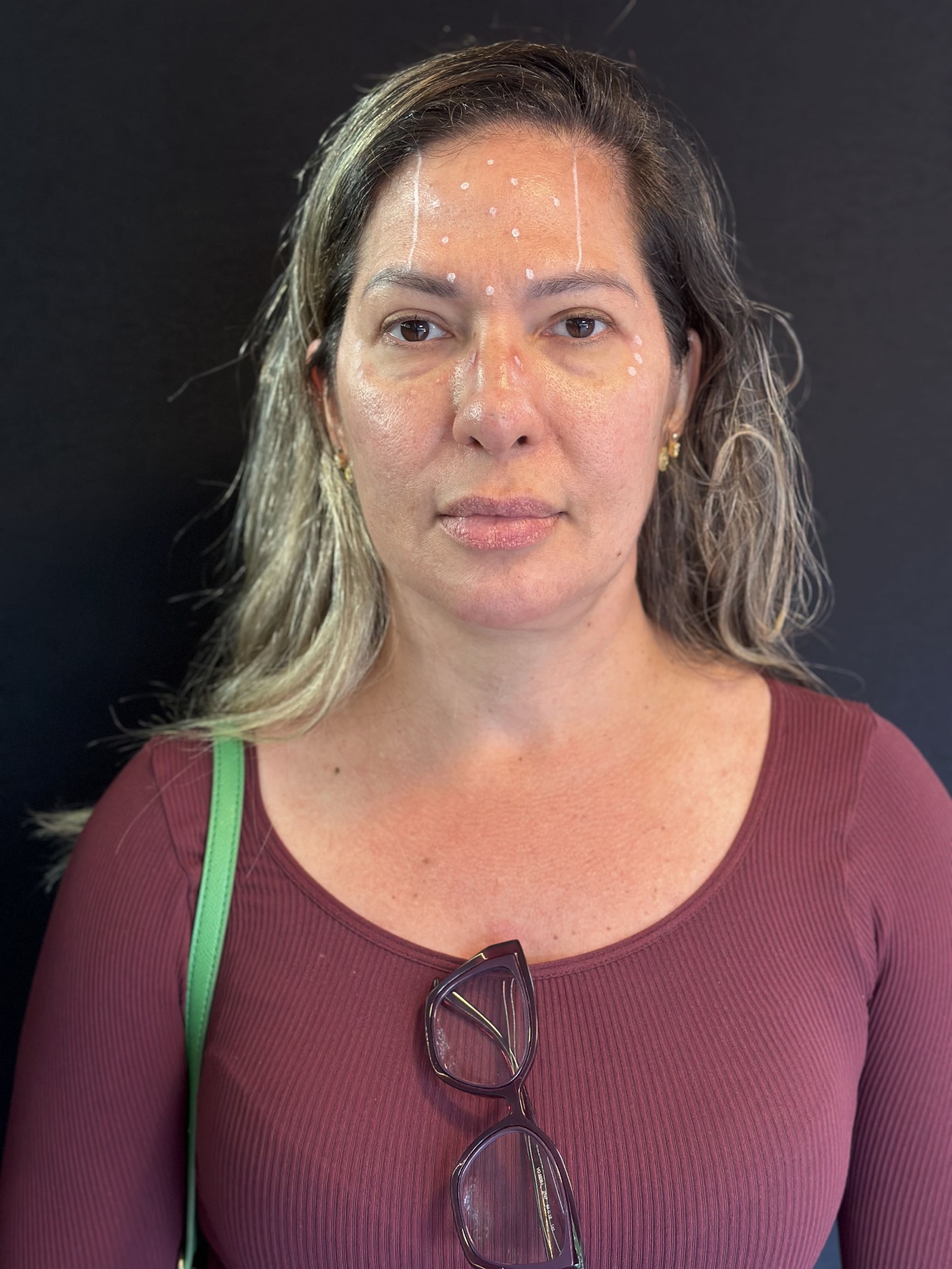 Antes - Rejuvenescimento