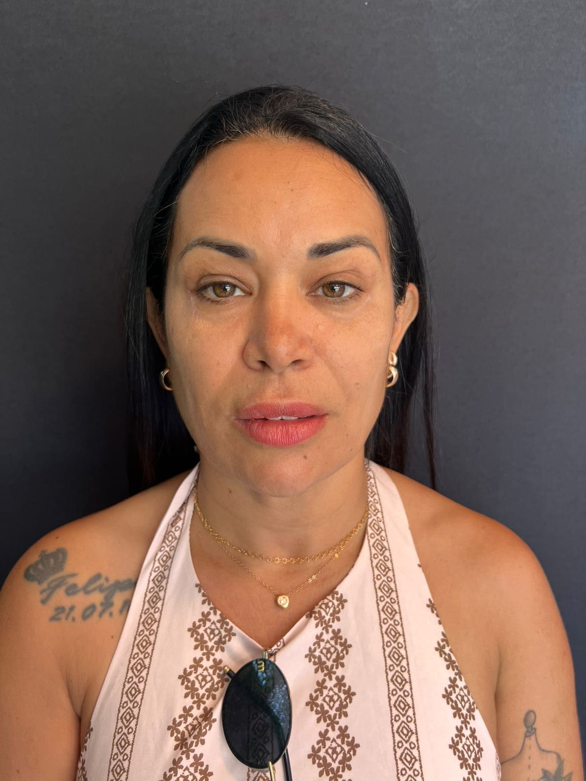 Antes - Harmonização facial